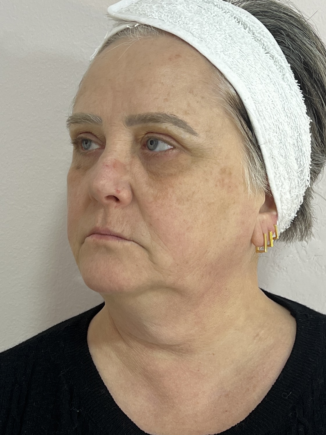 Paciente antes da harmonização facial - vista frontal